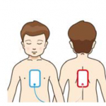 AED Pad Placement on small children 
